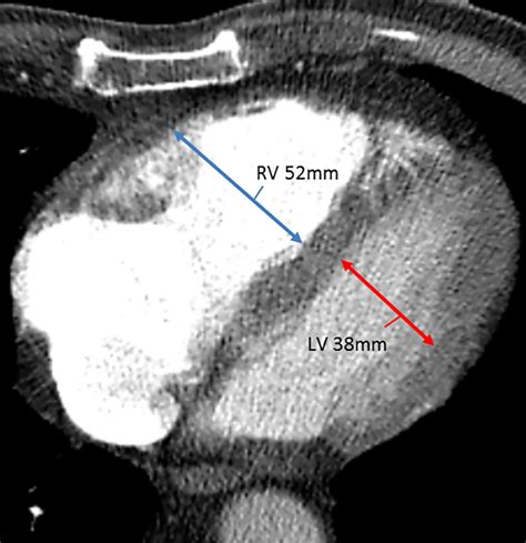 rv lv ratio radiopaedia